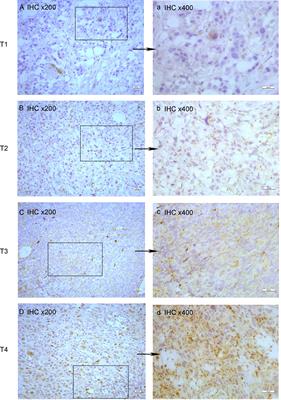 EPDR1 levels and tumor budding predict and affect the prognosis of bladder carcinoma